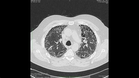 Axial Chest High Resolution Ct Scan In A Patient With