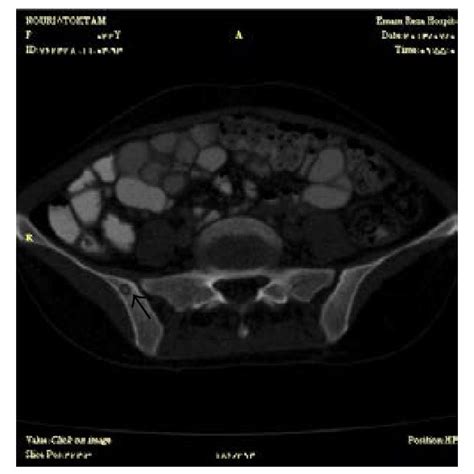 Computed Tomography Scan Shows Multiple Small Osteolytic Lesions