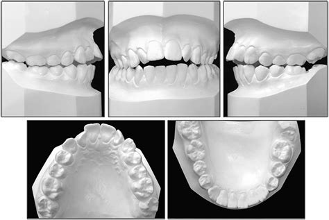 Orthodontic Treatment Of A Patient With Maxillary Lateral Incisors With