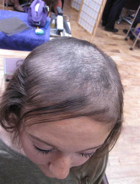 Pulling Out Hair Disorder Left Teen Bald But Now She Has The Locks Of