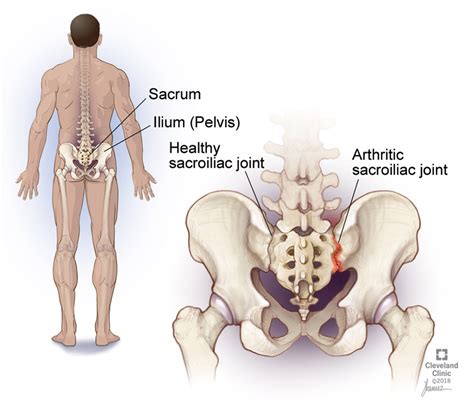 What Is A Sacroiliac Joint Injection Integrative Pain Spine Institute