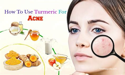 It boosts collagen production too, meaning your injury heals faster and scars less. Tips How To Use Turmeric For Acne Scars, Spots And Pimple ...