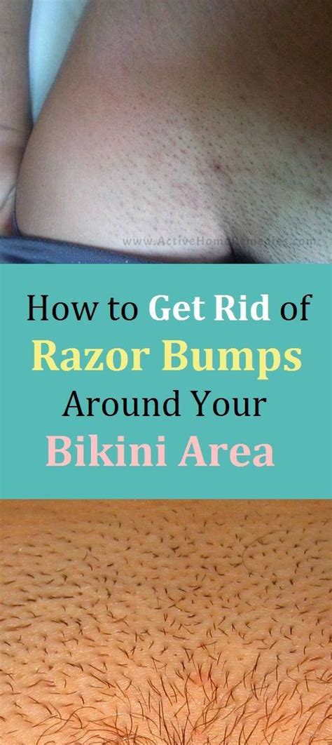 There are a range of good products on the market, all designed to help prevent ingrown hairs, bumps, and that awful red, itching rash after shaving. How to Get Rid of Razor Bumps Around Your Bikini Area ...