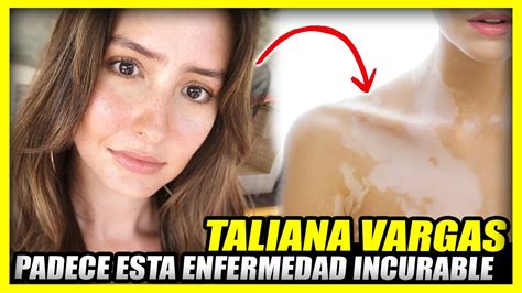 La Triste Historia De Taliana Vargas Y Su Lucha Con El Vitiligo Youtube
