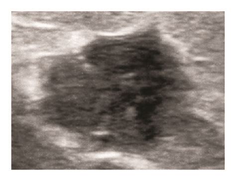 Ultrasound Examination Of The Axillary Mass Reveals A Hypoechoic Mass