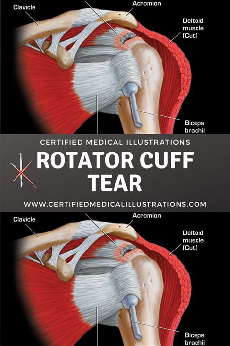 Anatomy Of Rotator Cuff Left Print Quality Instant Download