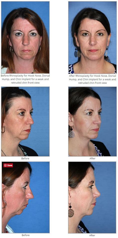 But it did make my nose smaller and got rid of a hump. Before & After Rhinoplasty for Hook Nose, Dorsal Hump, and ...
