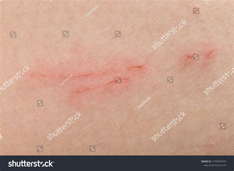 Scratch Marks On Skin Surface Cause Stock Photo 1740487076 Shutterstock