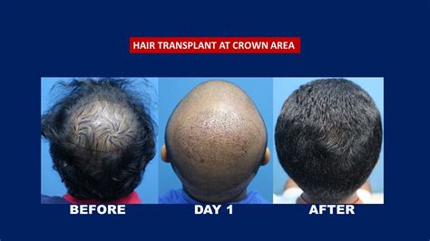 Crown Hair Transplant Before After Hair Transplant Centre Malaysia