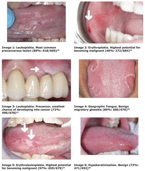 Detection Of Early Stage Oral Cancer Lesions A Survey Of California Dental Hygienists Journal