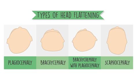 The Flat Head Syndrome Fix Cando Kiddo Flat Head Syndrome Baby
