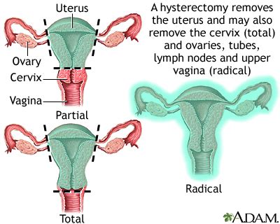 Hysterectomy Lima Memorial Health System