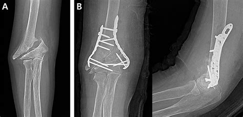 Open Reduction And Internal Fixation For Nonunion Of Extra Articular