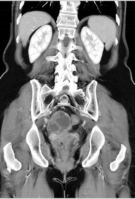 Cas article google scholar 6. Cystic Ovarian Cancer - OB/GYN Case Studies - CTisus CT ...