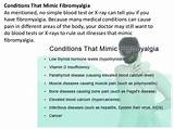 What Doctor Do You See For Fibromyalgia