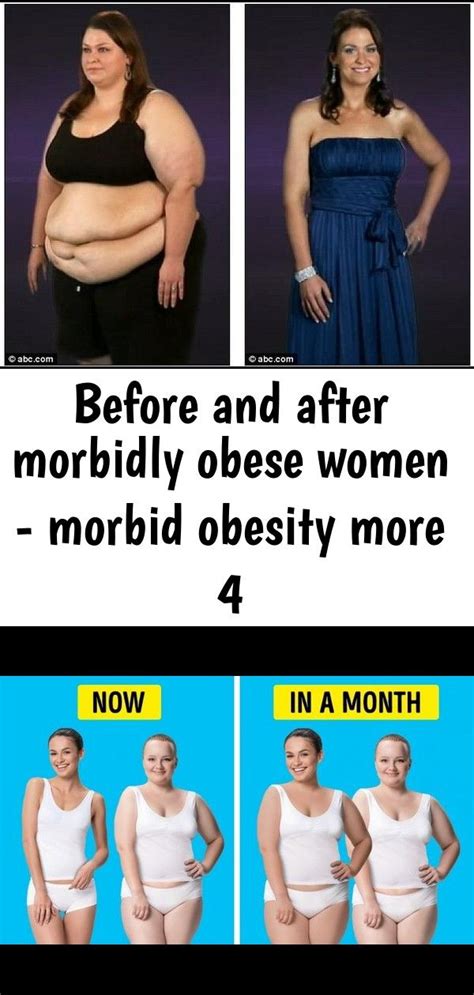 Before And After Morbidly Obese Women Morbid Obesity More 4 Obesity
