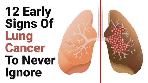 What Are The Early Signs Of Lung Cancer Symptoms Early Sign Of Lung Cancer You Should Know