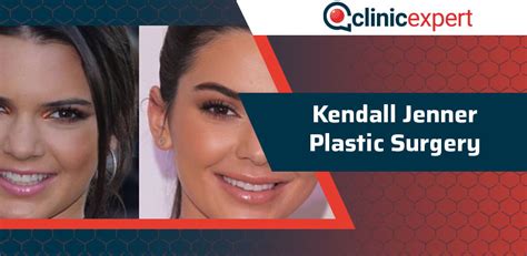 Kendall Jenner Plastic Surgery Process Clinicexpert