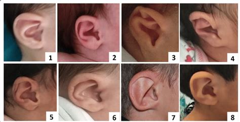 External Typical Aspect Of Ears In Our Patients Download Scientific