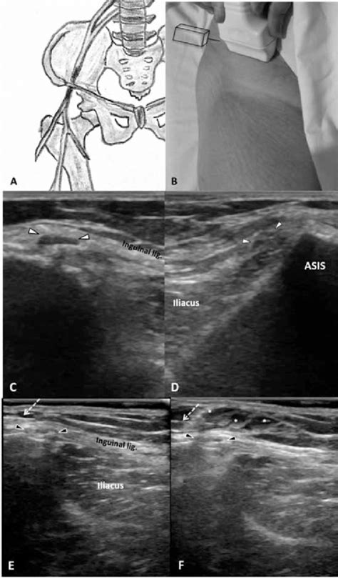 Ultrasound Guided Lateral Femoral Cutaneous Nerve Sifsof