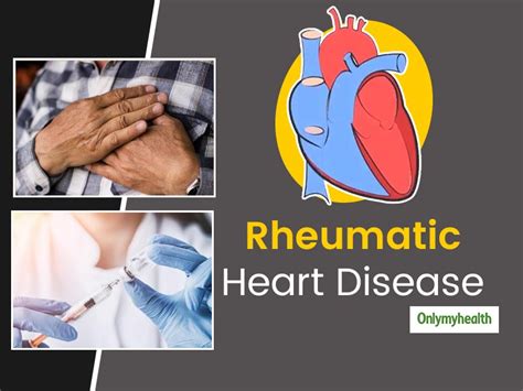 Rheumatic Heart Disease Causes Symptoms Diagnosis And