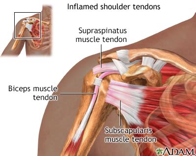 Pain in right shoulder can be caused by frozen shoulder, arthritis, gallstones and even cancer. Rotator cuff problems