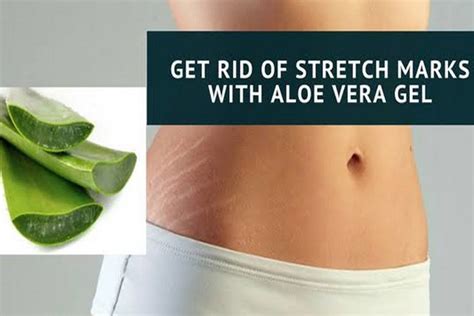 11 Useful Ways To Use Aloe Vera For Stretch Marks HerGamut