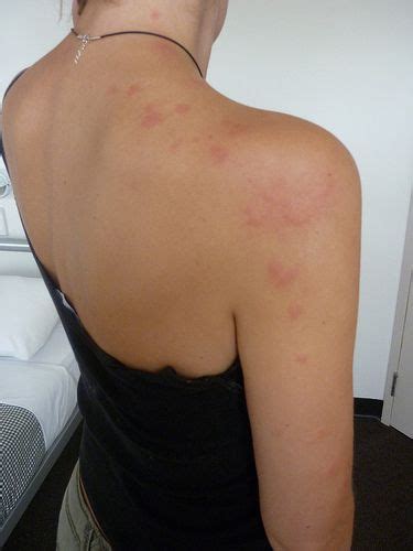 Bed Bug Bites Cause Hives And Rashes Bed Bug Bites Bed Bugs Signs