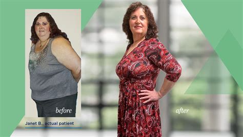 Gastric Bypass Before And After