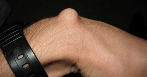 Another alternative, that some call traditional, others call a bit barbaric, is to smash the wrist ganglion cyst with a hard object such as a book. Ganglion cyst: Symptoms, causes, and treatment
