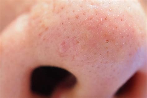 Premium Photo Pimple And Acne On Face Skin And Nose Zoom Macro Oily