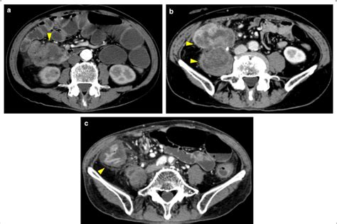 Abdominal Contrast Enhanced Ct A 80 Mm Bulky Mass With Markedly