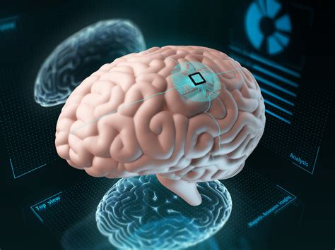 Can Implanted Computer Chips Cure Depression Mind Matters