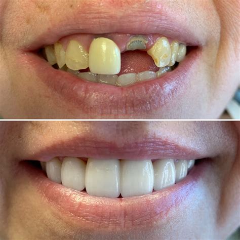 Dental Bridges Orillia On Replacement Teeth
