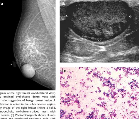 Pdf Epidermal Inclusion Cyst Of The Breast A Rare Benign Entity