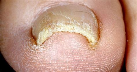 Toenail Fungus Cure Fast And Easy Treatment Of Toenail Fungus