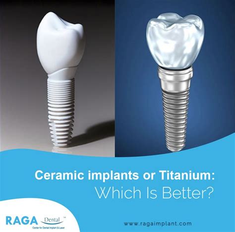 Titanium Implants Have Been Dominating Implant Dentistry Since Its