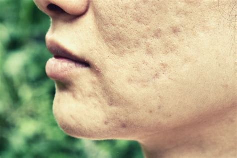 How To Get Rid Of Pitted Acne Scars Marqueus Draper