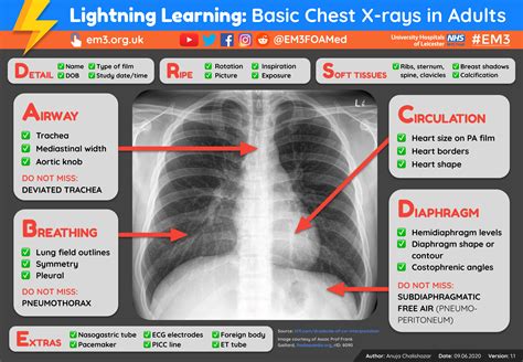 Lightning Learning Basic Chest X Rays In Adults — Em3