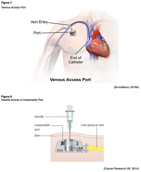 Vascular Access Devices Part 2 Nursing Ce Course Nursingce