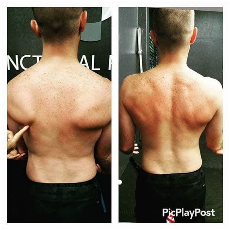 I am a 40 yo female with no family hx of heart problems and otherwise healthy. Addressing a scapular wing is a very easy thing to do if ...