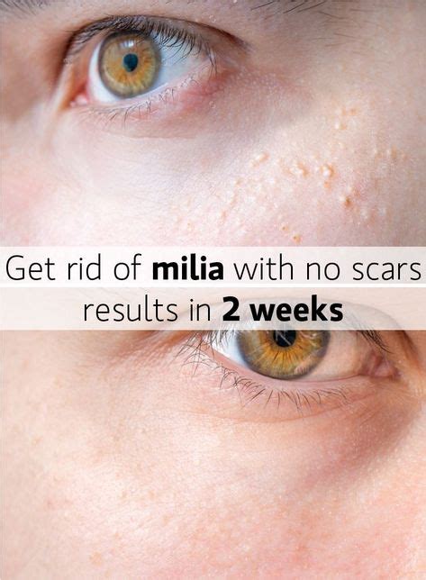 Milia How To Get Rid Of White Heads Glowing Skin Tips White Bumps