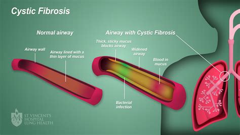 Cf Cystic Fibrosis St Vincent S Lung Health