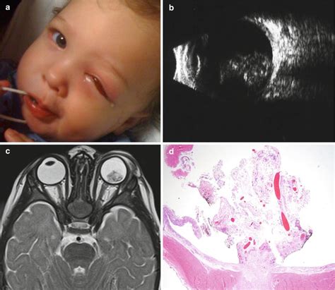 Despite leukocoria being a common presentation across the entire spectrum of pfv, leukokoria results from several differing underlying features including a the characteristic findings in the posterior pfv syndrome include leukocoria, microphthalmia, a retinal fold possibly causing tractional retinal. Differential Diagnosis of Leukocoria | Ento Key