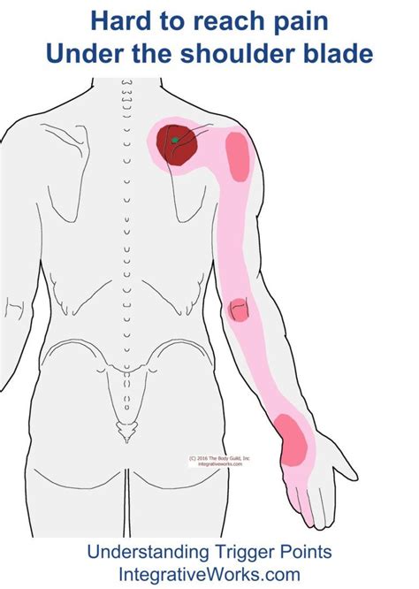 Pin On Shoulder Trigger Point Pain