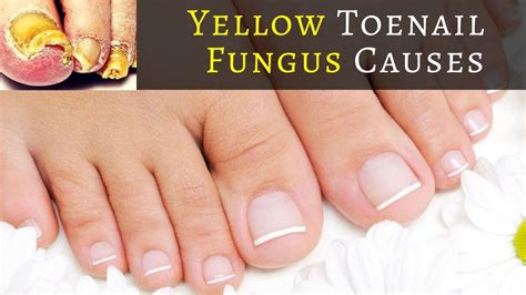 What Causes Yellow Toenail Fungus Warning Find Out What Causes Yellow