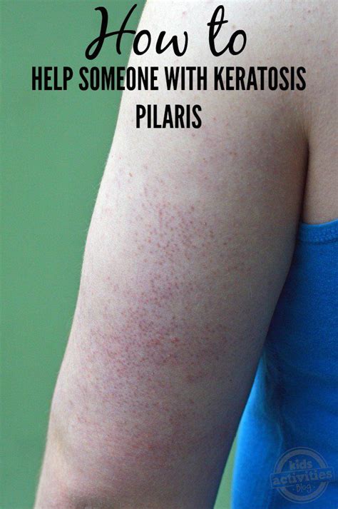 How To Help Someone With Keratosis Pilaris Keratosis Pilaris