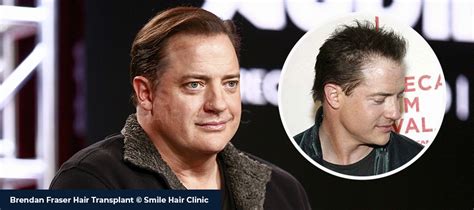 Brendan Fraser Hair Loss Hair Byte