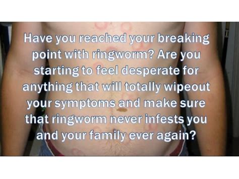 3 days ringworm treatment guide