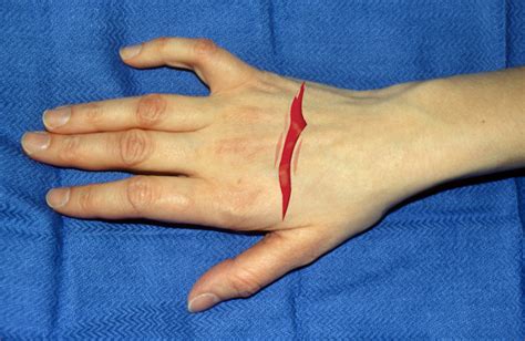 Laceration Open Wound Hand Surgery Resource